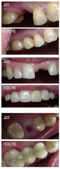 Микропротезирование зубов в Челябинске - профессиональная компетенция стоматологии 