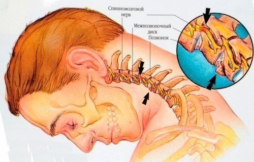 Цервикалгия (боль в шее)